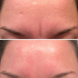 Frownies Facial Wrinkle Patches