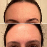 Frownies Facial Wrinkle Patches