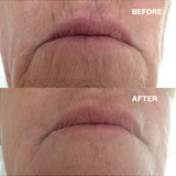 Wrinkles Schminkles Mouth and Lip Wrinkle Patches
